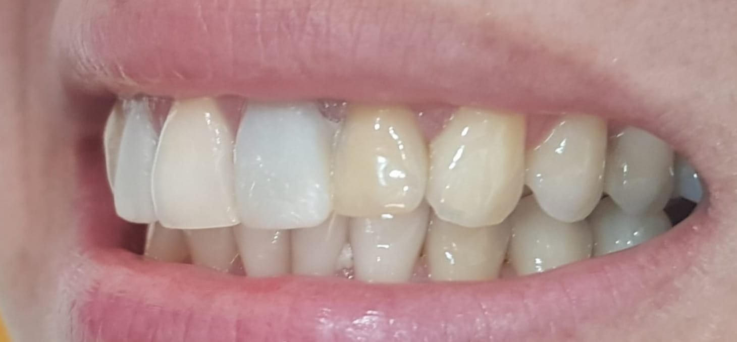 Caso 1 - Antes del tratamiento