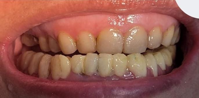 Caso 3 - Antes del tratamiento