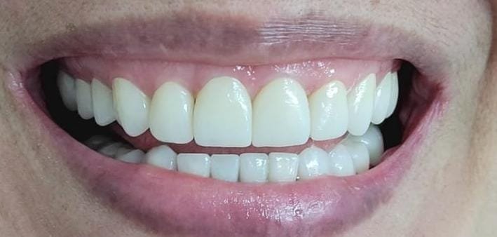 Caso 3 - Después del tratamiento