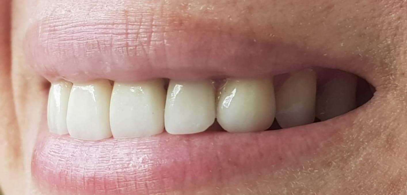 Caso 1 - Después del tratamiento